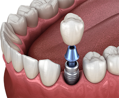 L'implant dentaire