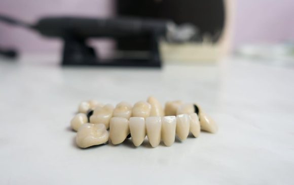 Couronne tout-céramique en zircone