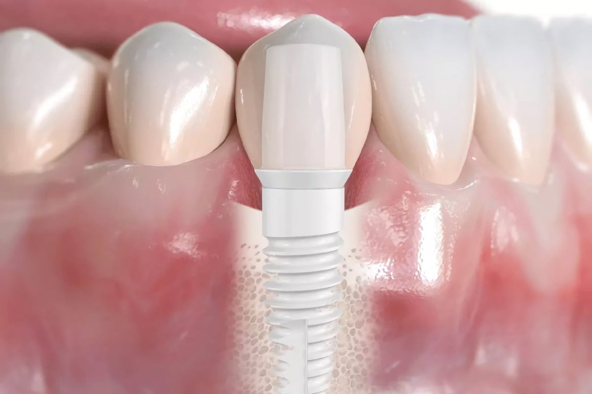 Pourquoi les implants en céramique sont-ils de plus en plus populaires ?