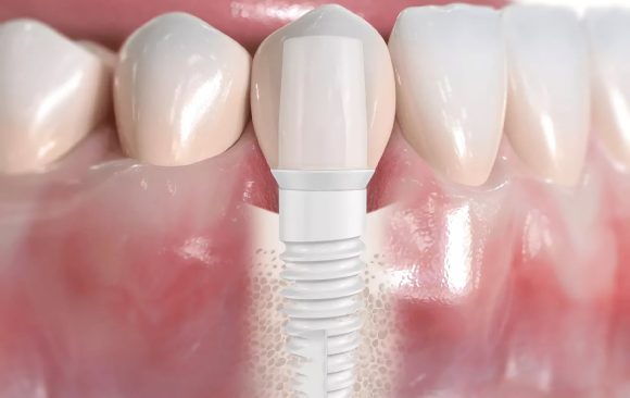 Pourquoi les implants en céramique sont-ils de plus en plus populaires ?